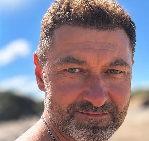Saç ekimi: tepe ve ön bölge – Sonra
