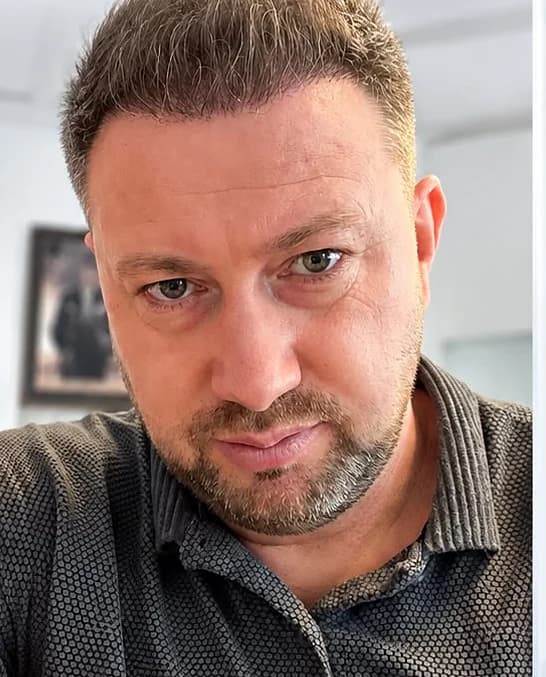 Saç ekimi: 4. ay kontrolü – Sonra